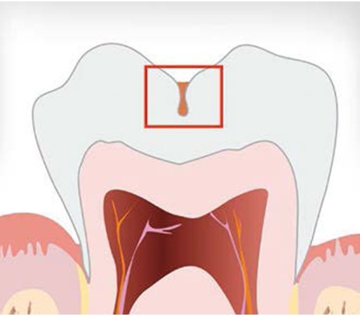 Показания и противопоказания к герметизации фиссур