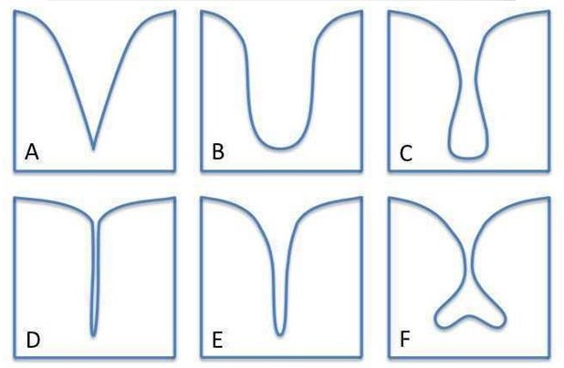 Формы углублений на эмали