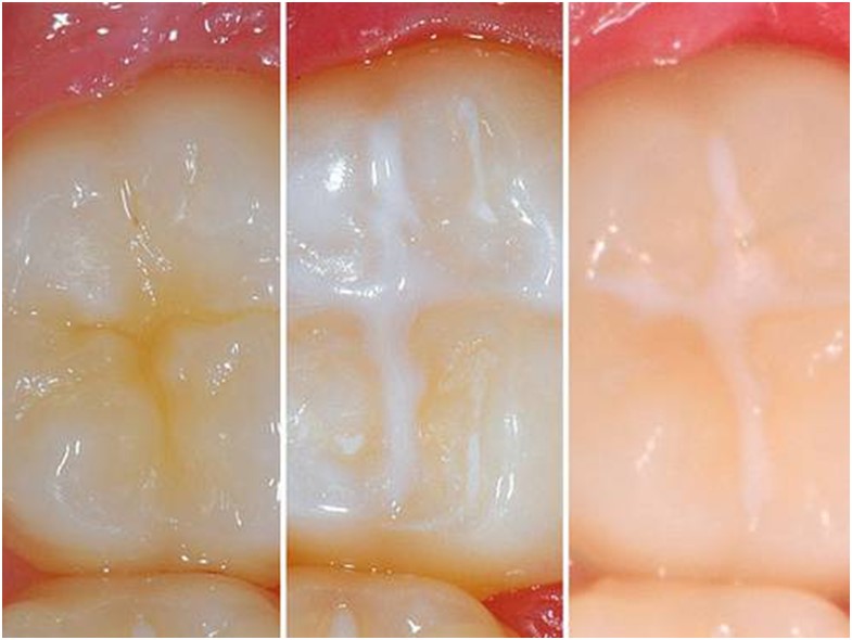 герметизация глубоких фиссур